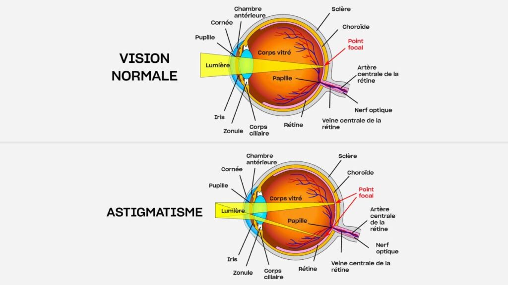 difference hypermetrope myope presbyte astigmate (2)