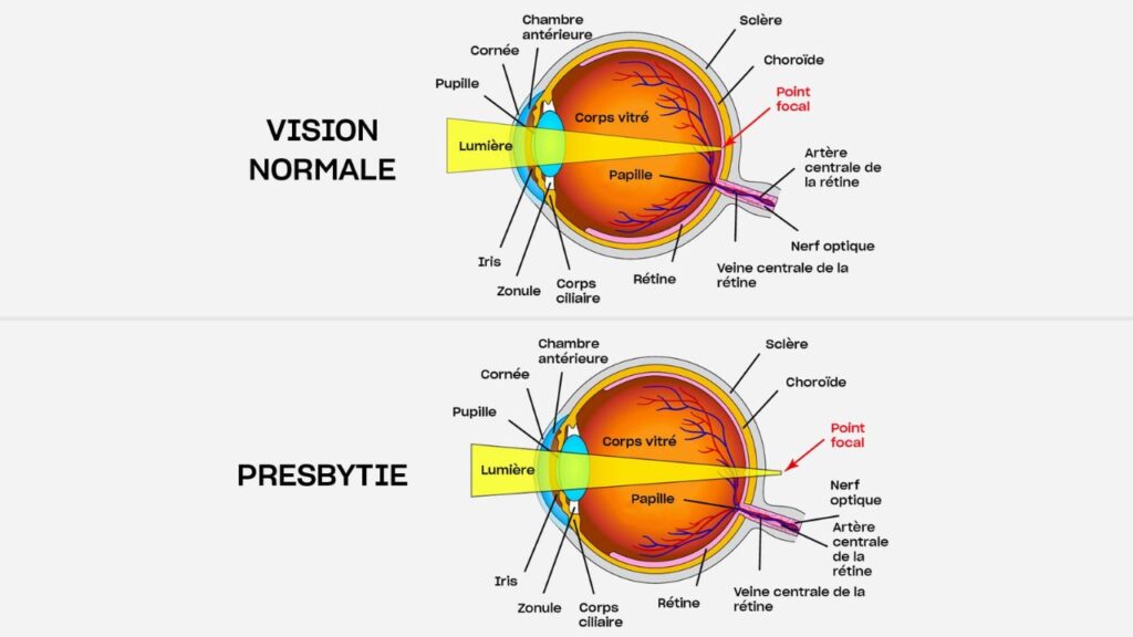 difference hypermetrope myope presbyte astigmate (2)